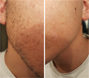 résultat fluide de rasage dermofluide